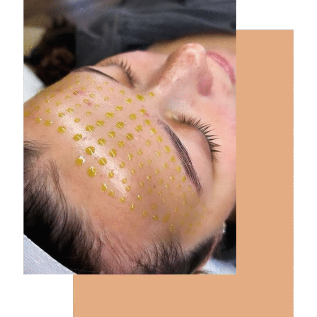 Facial SPA in Hummelstown offering scar reduction and pigment therapy with advanced Jet Plasma and BioRePeel.