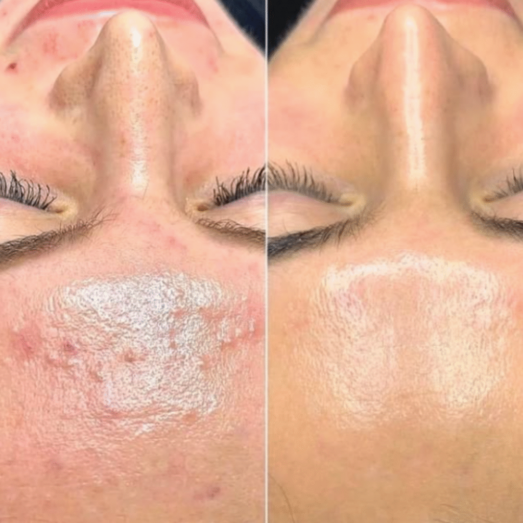 Long-lasting acne facial results at Facial SPA in Hummelstown with glowing, healthy skin.