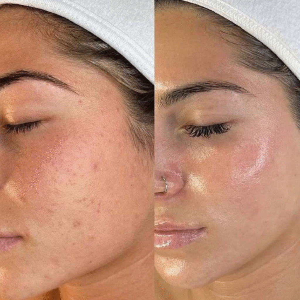 Acne facial results at Facial SPA in Hummelstown showing clear, smooth, and radiant skin.