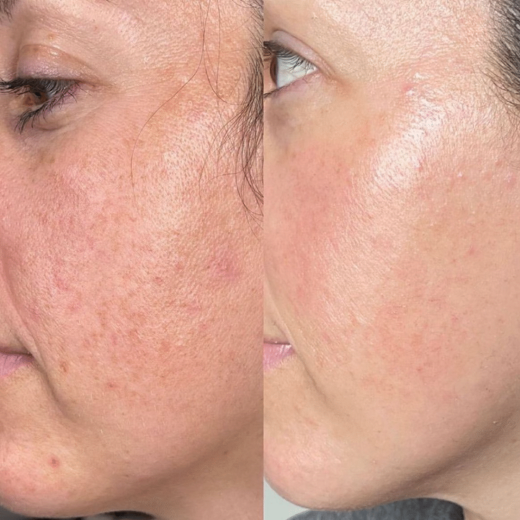 Before and after facial results at Pelle Sana Facial Spa in Hummelstown PA showing clear, radiant skin.